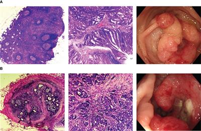 Overexpression of circulating CD38+ NK cells in colorectal cancer was associated with lymph node metastasis and poor prognosis